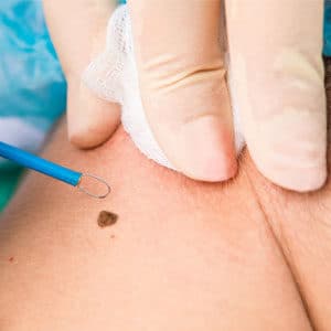 Skin Cancer removal & Reconstruction
